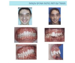 יישור שיניים ברחובות