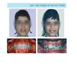 יישור שיניים ברחובות